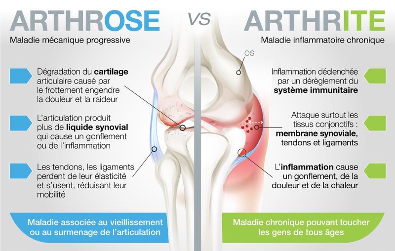 arthrose VS arthrite